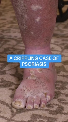 Managing Severe Psoriasis Symptoms: A Comprehensive Guide
