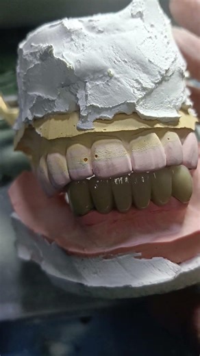 6 units porcelain jacket crown bridge finally GLAZING