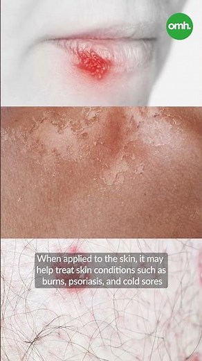 Home Remedies to Get Rid of Dandruff Naturally I OnlyMyHealth