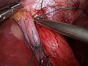 laparoscopic fundoplication for heartburn by Dr Craig Taylor Sydney