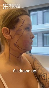 Deep Plane Face & Neck Lift Transformation! 💖 Ready for your own rejuvenation journey? At Booking Surgery, we make premium facial aesthetic procedures safe, seamless, and accessible in Türkiye. 🌟 All-Inclusive Package Includes: ✅ VIP Airport Transfers ✅ Private Hospital Room ✅ 24/7 Translator Support ✅ Pre-Op Tests & Consultation ✅ General Anaesthesia & Hospitalisation ✅ Expert Nursing Care ✅ Take-home Medication ✅ Meals for You & Your Companion — who stays free! 📍 With Booking Surgery, you’r