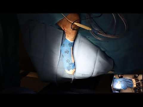 Toe amputation and popliteal lymph node removal in a dog