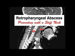 Neck Stiffness with Retropharyngeal Abscess • Video • MEDtube.net