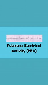 Pulseless Electrical Activity of the Heart simplified #fypreelsシ゚viralシ | Ma Vickie