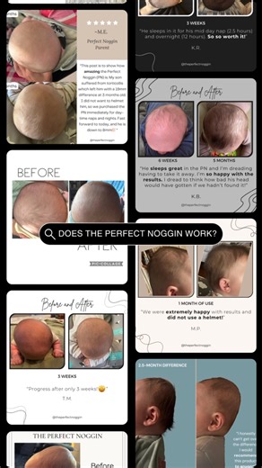 The Perfect Noggin | The Noggin Doctor on Instagram: "Does the Perfect Noggin work? Does it actually maintain natural head shape? Let our results speak for themselves and head over to our website (link in the bio) to see our publications😊 Find this helpful? ✅ SAVE this to your “Plagio” list ✅ SHARE with a mama & ✅ FOLLOW @theperfectnoggin to learn more! #Plagiocephaly #FlatHeadSyndrome #momlife #ParentingSupport #BabiesOfInstagram #HeadShape #PerfectNoggin #LoveYourBaby #ParentingCommunity #new