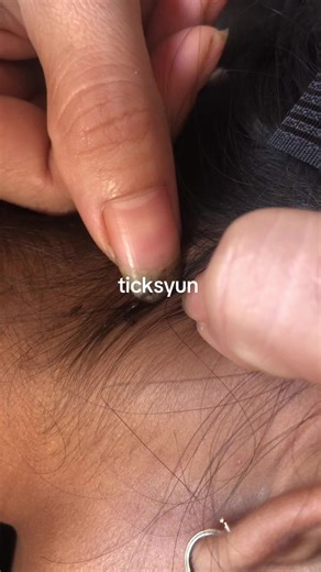 #lice #omg #fvp #liceremoval #ticksyun | lice removal