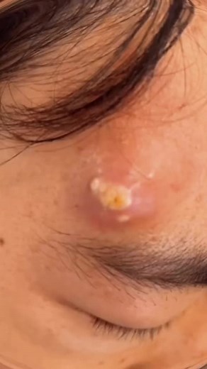 Effective Blackhead and Acne Extraction Techniques