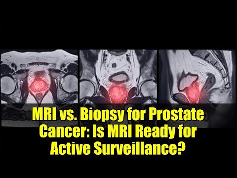 MRI vs. Biopsy for Prostate Cancer: Is MRI Ready for Active Surveillance?