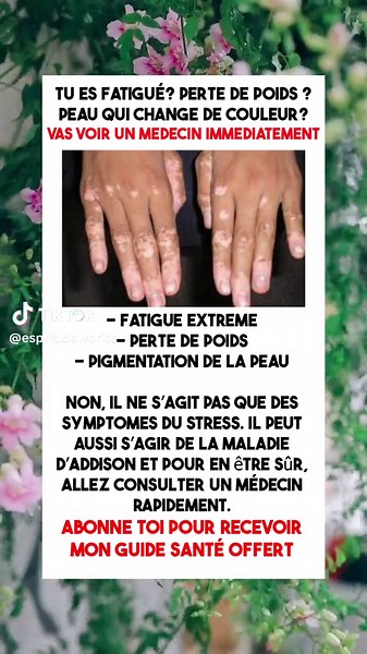 La maladie d'Addison, également connue sous le nom d'insuffisance surrénalienne primaire, est une affection rare qui affecte les glandes surrénales, situées au-dessus des reins. Cette maladie, décrite pour la première fois par le médecin britannique Thomas Addison au 19e siècle, se caractérise par une production insuffisante d'hormones corticosurrénales, en particulier de cortisol et d'aldostérone. Comprendre les causes, les symptômes, les diagnostics et les traitements de la maladie d'Addison e