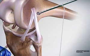 RIGIDLOOP™ Adjustable可调节线圈钛板操作动画中文版上线了