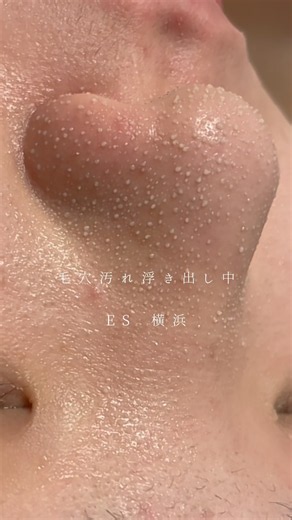黒ずみ毛穴が白く浮き上がりツルツル鼻に👃🏻#角栓