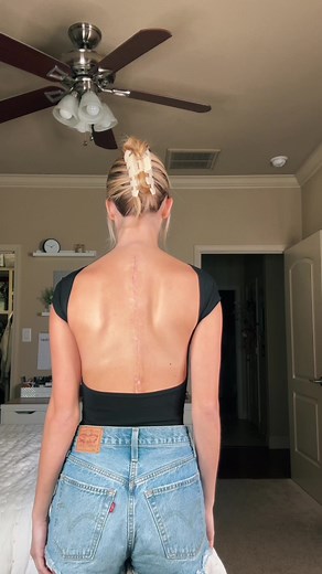 6 Weeks Post Surgery Recovery Update - Paige Mackenzie TikTok