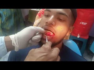 lower left side 2nd molars Broken tooth extraction...