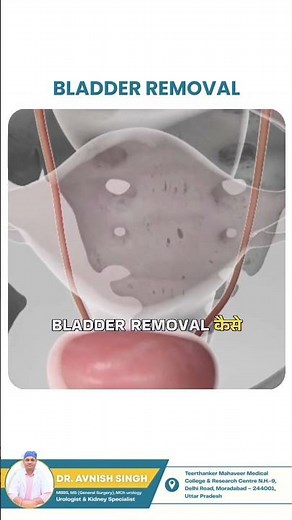 Bladder Removal Surgery Explained | What Really Happens During a Cystectomy?