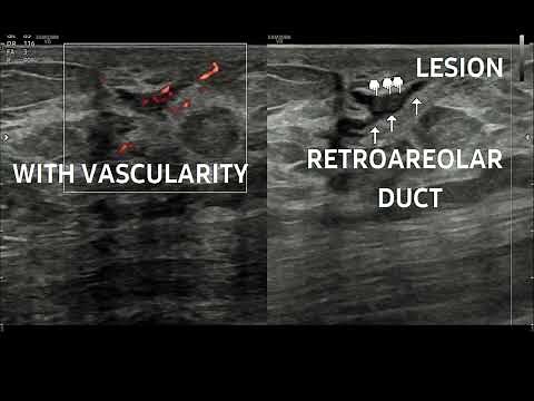 Breast Ultrasound - Solitary Intraductal Papilloma in right breast