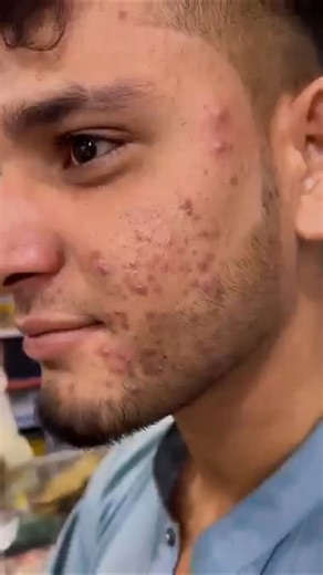 . pimple under microscope 🤒 #shortsviral #viral #facts #ytshorts