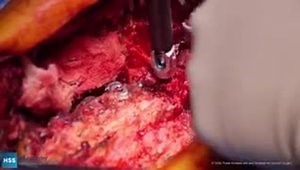 Revision Spinal Fusion T11 Pelvis/L4 PSO: Exposure and Revision Instrumentation