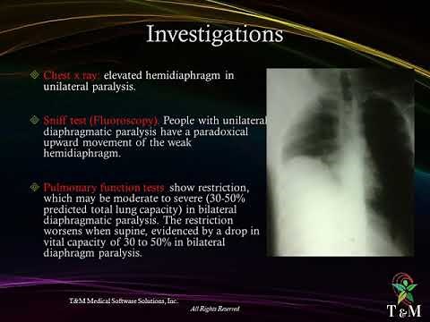 Diaphragmatic paralysis