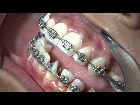 Orthotrain Demo- Lingual button - Procedure And Alternatives