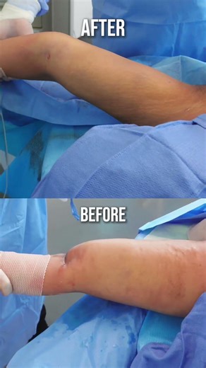 True Arm Lipo 360… This Isn’t Standard Arm Lipo 😳 #plasticsurgery