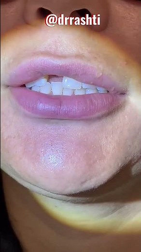 It’s amazing what one missing tooth can do to your appearance! This is a single implant replacement.