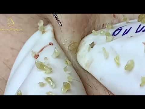 Top Dermatologist Reveals BEST Acne Treatment Techniques