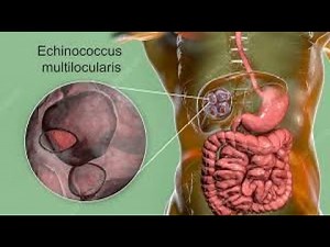 Alveolar echinococcosis ; Definition, Transmission, Symptoms, Diagnosis, Treatment
