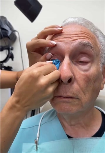 EyePrintPRO scleral lenses are a custom-fit device tailored to the unique contours of an individual’s eye. This technology creates a precise impression of the cornea, providing quality vision to patients. @Hayden H #sclerallens #sclerallenses #contactlens #eyeprintpro