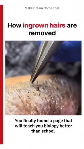 🌿How ingrown hairs 🪮 are removed | MDCT