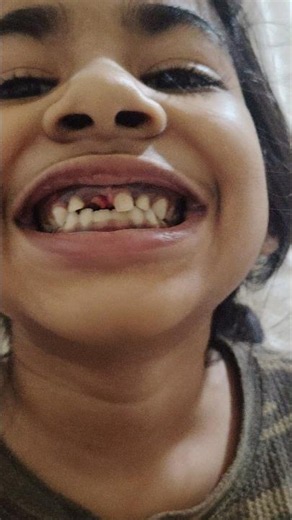 Pulling Out My Loose Baby Tooth! 😲