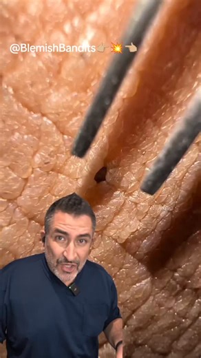 John Parente on Instagram: "Duet with @blemishbandits #derm #pimplepopper #satisfying"