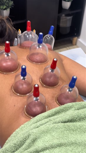 The power of AI 🤖✨ Today we had a lovely client who told us she actually found our clinic through ChatGPT — something we didn’t even realise people were using to discover local businesses! Out of curiosity we checked… and there we were, right at the top of the recommendations. How amazing is that! After seeing our reviews and the feedback from our clients, she booked straight away. Just two hours later she was in the clinic enjoying one of our most popular treatments — cupping therapy combined 