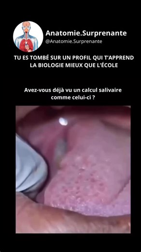 Anatomie Surprenante on Instagram: "Il s’agit d’un calcul salivaire (sialolithe) - une masse calcifiée qui se forme à l’intérieur d’une glande salivaire ou de son canal. Comment il se forme : La salive contient des minéraux comme le calcium et le phosphate. Lorsque le flux salivaire ralentit (déshydratation, sécheresse buccale, médicaments, infections), ces minéraux peuvent cristalliser, couche par couche, un peu comme une perle, mais en beaucoup moins joli. Pourquoi c’est un problème : Lorsque 