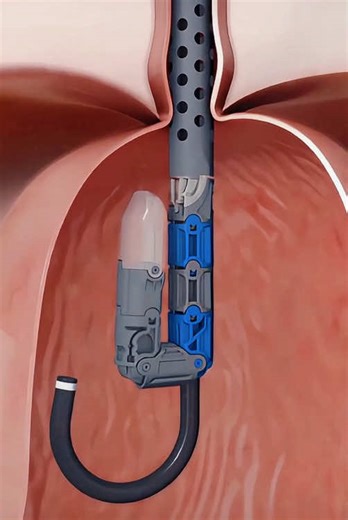 How Incisionless Fundoplication Surgery Is Performed (3D Animation) #endoscopicsurgery #gerd #acidreflux #3dmedicalanimation #medical3danimation
