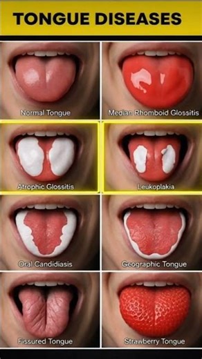 8 Tongue Diseases That Could Reveal Hidden Health Problems