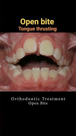 Braces can change your smile! OPEN bite #braces #orthodontist #smilemakeover #dentist