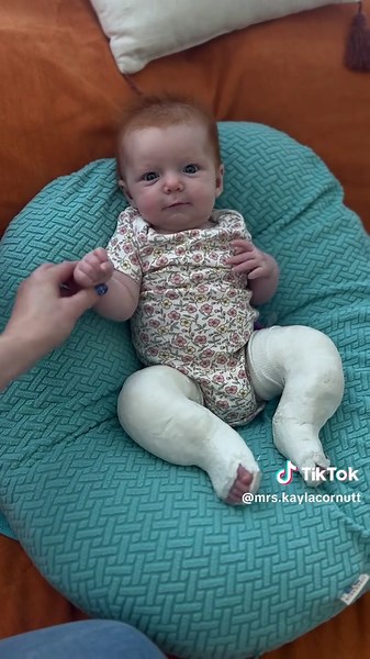 Paisley’s out of casts! This was the day before & as you can see she’s very excited ❤️ #clubfoot #clubfootjourney #baby #newborn #mom