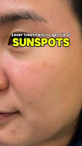 4.2K views | Laser treatment to get rid of Sunspots & even out skin tone ✨ Procedure: Brightening Laser ⏲️Duration of procedure: 30minutes Pain: None ⏳Downtime: No Downtime Results: Brighter & even skin tone, tighter pores Questions? Send us a message! ☎️ 0967-1956341  kashdermatology@gmail.com#CapCut | Dr. Kash Dermatology | Facebook