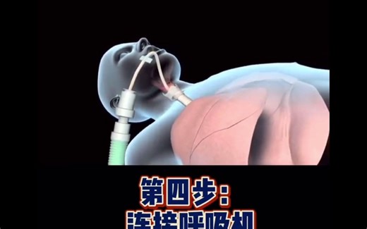 【3D动画演示—气管插管】学会我给你练手！