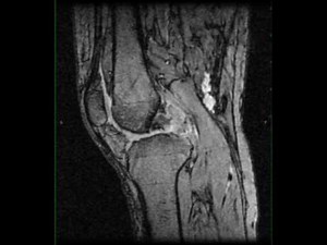 Pigmented Villonodular Synovitis, Knee