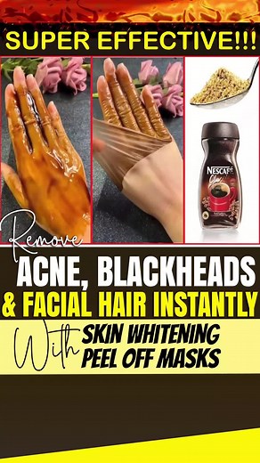 Remove Blackheads and Get rid of Acne Pimples | Remove Acne, Blackheads, and Facial Hair Instantly with This Skin Whitening Peel Off Mask #blackheadsremoval #blackheads #acnetreatment #facialhair #blackheadsremover #blackheadsremove #acneprevention #acneskin #foryou #foryoupage #fyp #fypシ゚viral