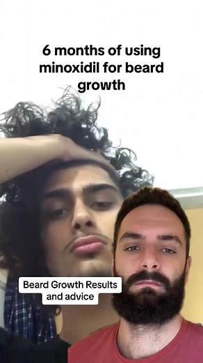6 Months Beard Growth Transformation Results