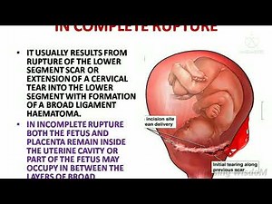 UTERINE RUPTURE