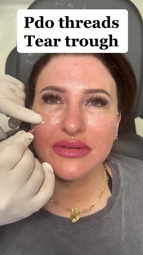 Pdo threads are place in the tear trough region (under eyes). Why did ...