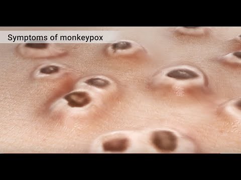 Mpox (Monkeypox) Animation