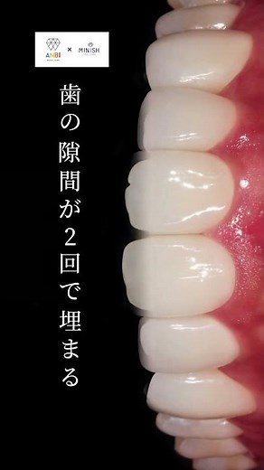 ミニッシュなら、歯の隙間が2回で埋まる！ #歯医者 #歯