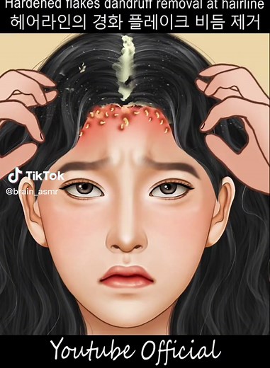 Effective Dandruff Removal at Hairline | Satisfying Animation