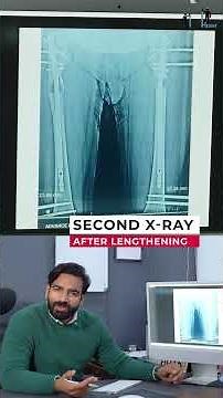 Femur Lengthening: X-ray Progression & Bone Formation Process Explained