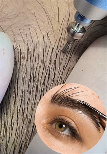Eyebrow Transplant Workshop: Transform Your Look
