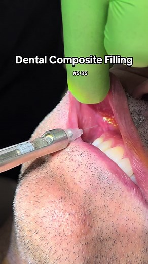 Composite restoration abfraction on tooth number 5 #dentaloffice #dentist #composite #restoration